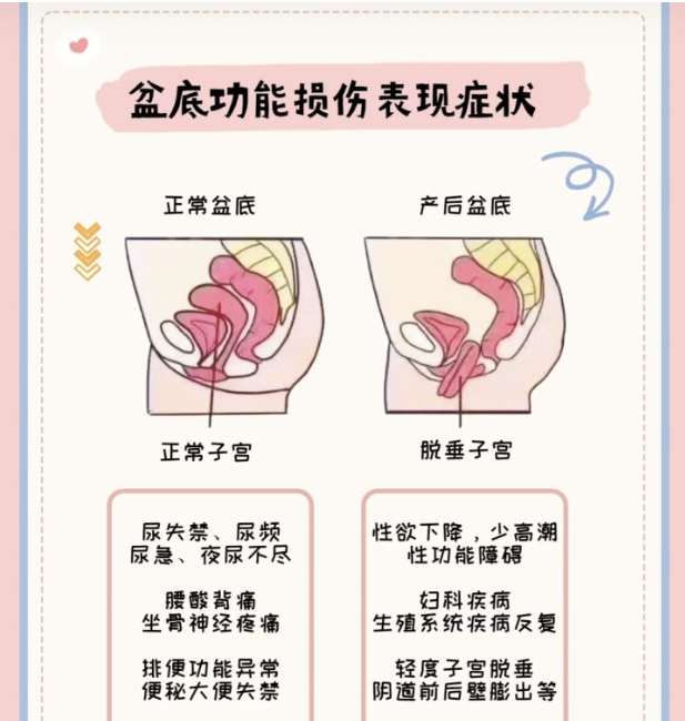 为什么要做产后盆底康复